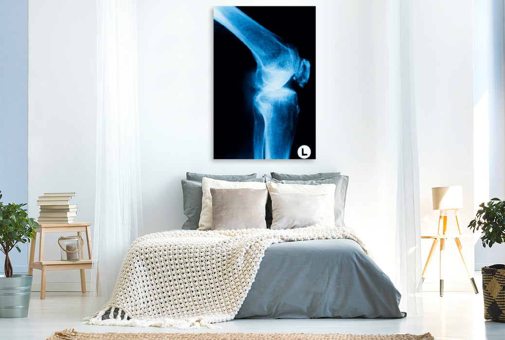 Premium Textil-Leinwand Premium Textil-Leinwand 80 cm x 120 cm  hoch Röntgenbild von einem Kniegelenk.